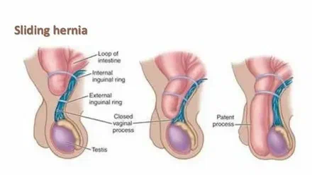 Hernia Surgery Auckland Options: Open vs Laparoscopic Procedures Explained
